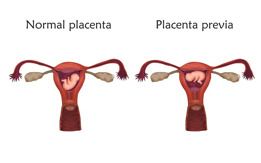 What Is Placenta Previa? Miami Center of Excellence Dr. Randy Fink Miami OBGYNS
